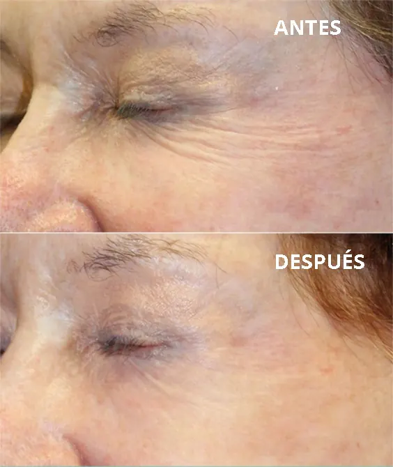 Enpitsu antes despues
