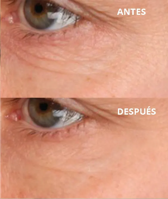 Enpitsu antes despues