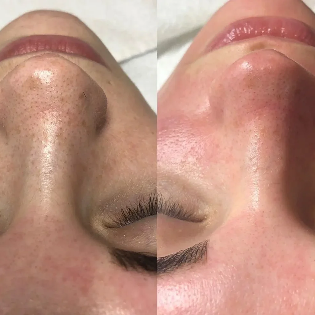 Antes y despues hydra vacuum