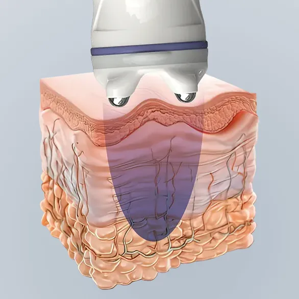 RF Bipolar