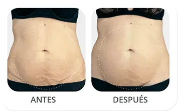 Antes despues corporal