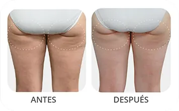 Antes despues corporal