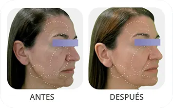 Antes despues facial