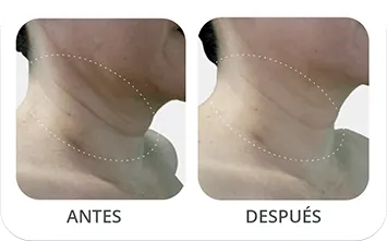 Antes despues facial