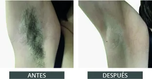 Antes despues elysion pro