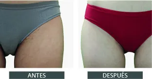 Antes despues elysion pro