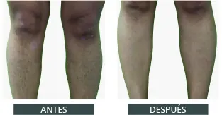 Antes despues elysion pro