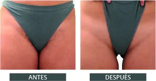 Antes despues elysion pro