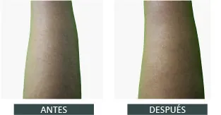 Antes despues elysion pro