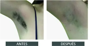 Antes despues elysion pro