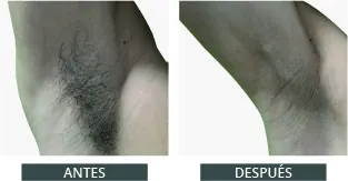 Antes despues elysion pro